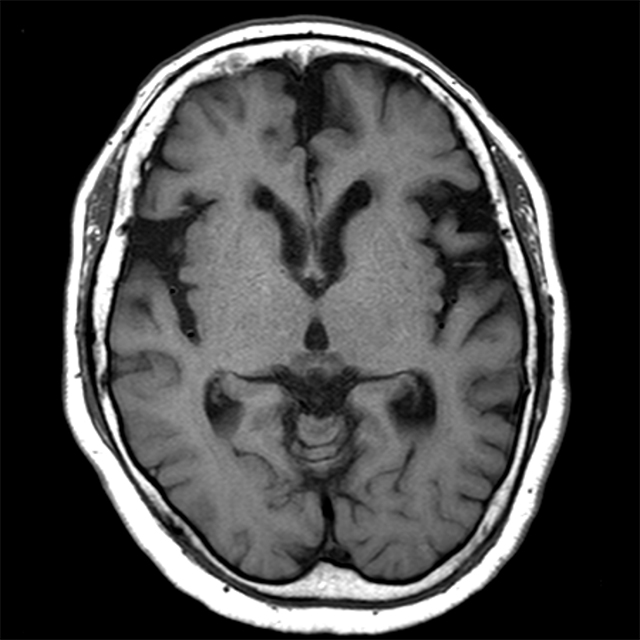 アルツハイマー病初期のMRI所見