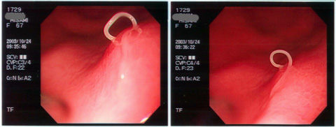 アニサキスの内視鏡像